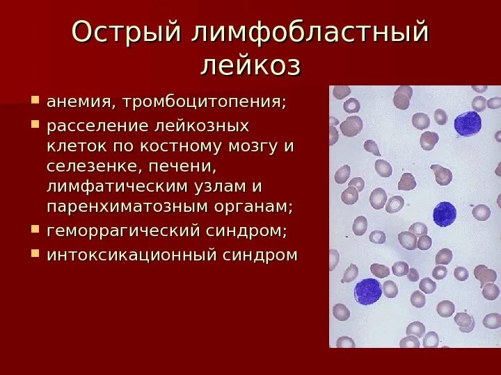 Селезенка лейкоциты. Острый лимфоцитарный лейкоз. Острый лейкоз и хронический лимфолейкоз. Симптомы острого лимфоцитарного лейкоза. Острый лимфобластный лейкоз в2 иммунный.