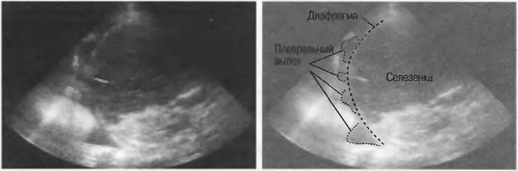 Добавочная селезенка на УЗИ. Дополнительная долька селезенки на УЗИ. Полиспления селезенки.