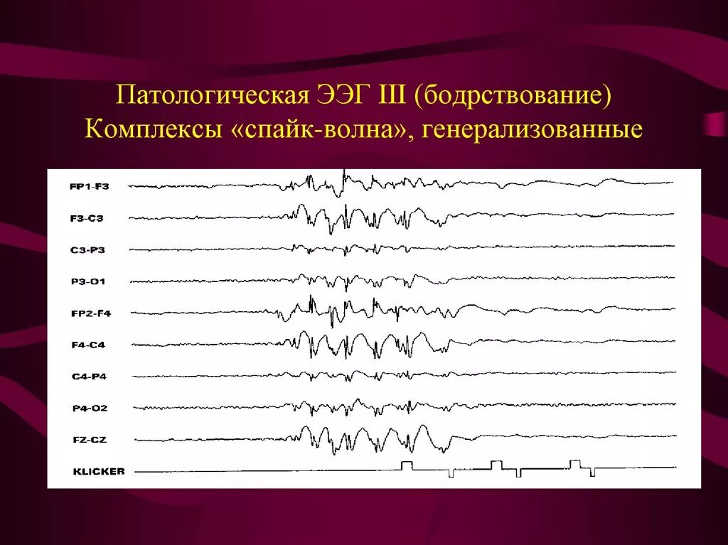 ЭЭГ эпилепсия пик-волна. Комплекс Спайк медленная волна на ЭЭГ. Эпилептиформная активность на ЭЭГ. Спайк волновая активность на ЭЭГ. Медленные волны на ээг