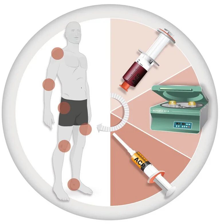 Плазма лечение суставов отзывы. Prp-терапия плазмотерапия. prp терапия platelet rich plasma. плазмолифтинг prp терапия коленного сустава. плазмотерапия суставов (prp-терапия, плазмолифтинг).