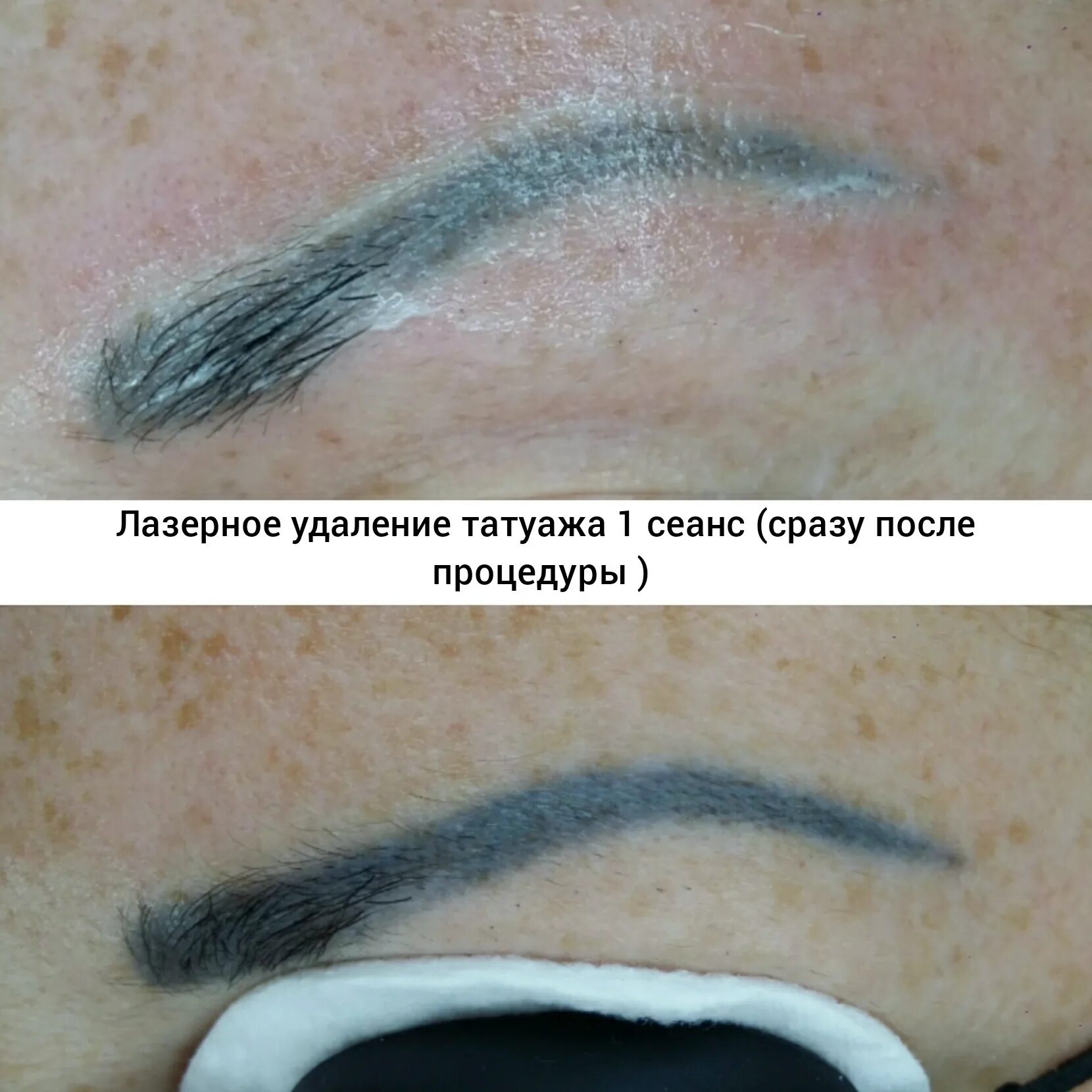 Удаление татуажа в Москве. Лазерное удаление татуажа в салоне по низким ценам Ли