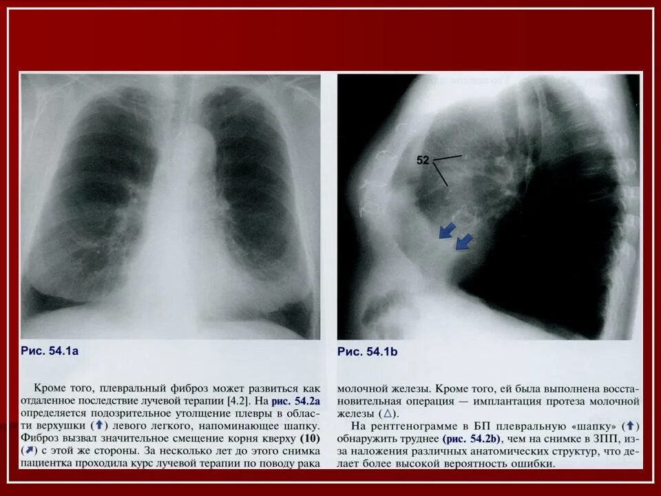 Плевральные наслоения рентген ОГК. Плевральная шварта рентген. Фиброз апикальной плевры что это.