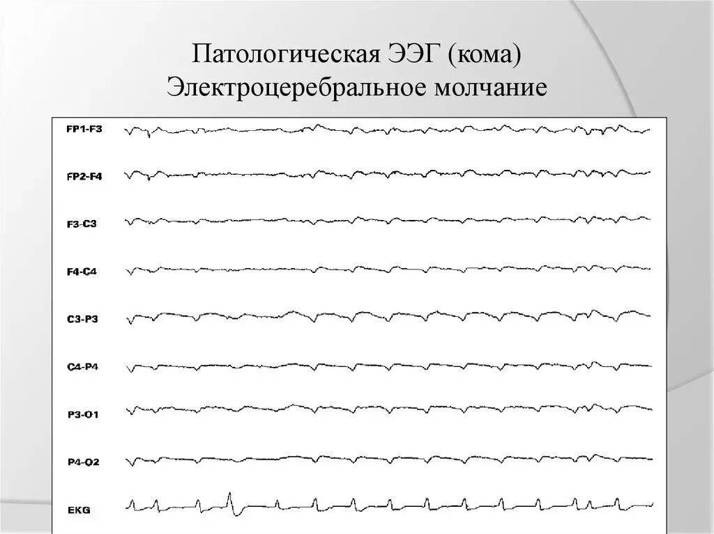 Ээг индексы. ЭЭГ волны патологические. Нормальная диаграмма ЭЭГ. Патологические ритмы ЭЭГ. ЭЭГ при патологии.