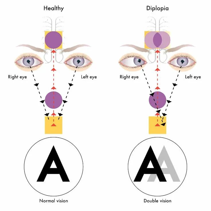 Двоение в глазах. Диплопия. Нарушение зрения диплопия. Двоение в глазах диплопия. Левый глаз темнее правого