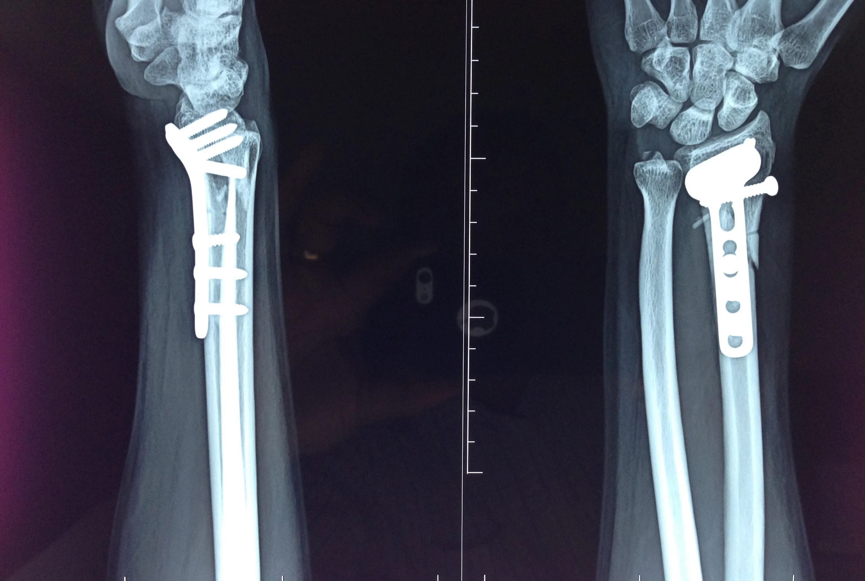 Radius fracture. Radius fracture