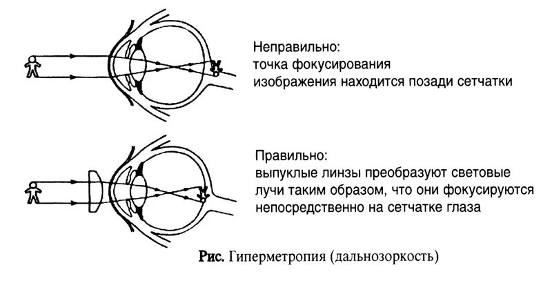 Фокусировка глаза человека. Патология рефракции гиперметропия. Схема глаза при близорукости. Схемы миопии и дальнозоркости. Дальнозоркость схема глаза.