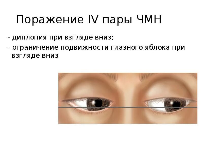 Причины диплопии бинокулярной. Двоение в глазах диплопия. Диплопия при взгляде. Диплопия клинические проявления. Методика исследования диплопии.