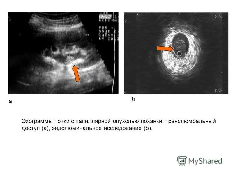 Опухоли почечной лоханки метод диагностики. Опухоль почечной лоханки. Опухоли почек, лоханки и мочеточника. Опухоль мочеточника узи. Опухоли почечной лоханки метод диагностики.