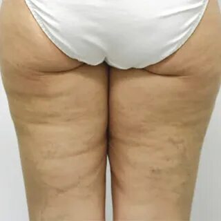 Целлюлит бар мега-үлкен бөкселердің фотосуреттері