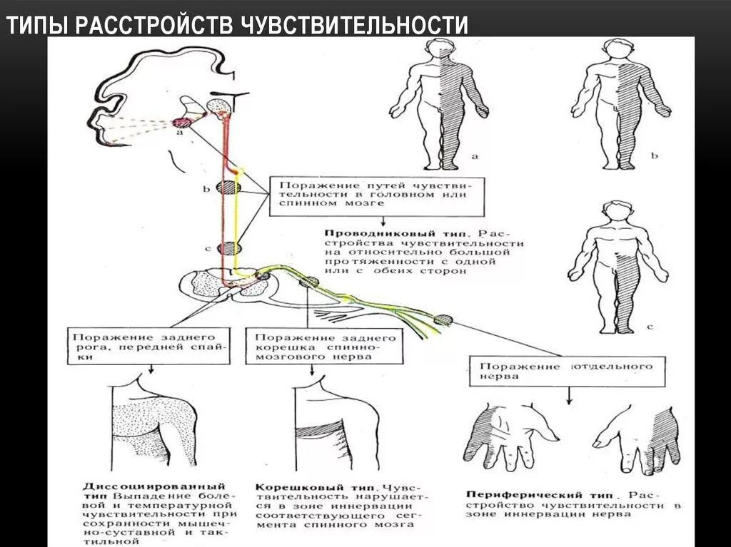 Типы расстройств чувствительности неврология. Типы нарушения чувствительности неврология. Признаки периферического типа расстройства чувствительности. Корковый Тип нарушения чувствительности неврология.