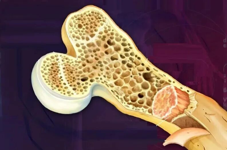 Строение губчатой ткани кости. Губчатое вещество костной ткани. Трабекулярная структура кости. Губчатое и трубчатое вещество кости. Костный мозг содержится