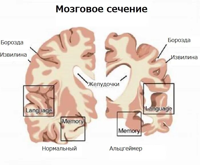 Болезнь айцгельмера это что. Болезнь Альцгеймера. Синдром Альцгеймера. Мозг человека при Альцгеймера.