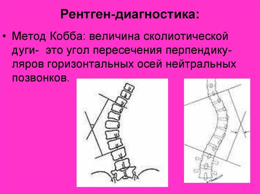 Сколиоз по коббу рентген. Угол Кобба по чаклину. Метод Кобба сколиоз. Угол сколиоза метод Кобба. Угол кобба