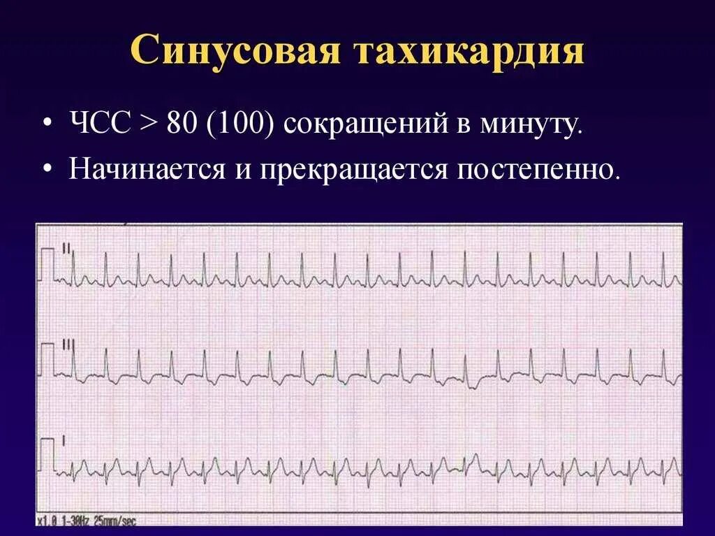 Тахикардия лечится или нет. Синусовая тахикардия экг признаки. синусовая тахикардия максимальная чсс. чсс при синусовой тахикардии. экг тахикардия синусовый ритм.