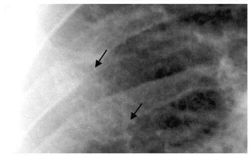 Перелом ребер карта вызова скорой медицинской помощи. Заключение травматолога после дтп перелом ребер. Перелом ребер мкб. Перелом ребер мкб. Артифакия мкб.