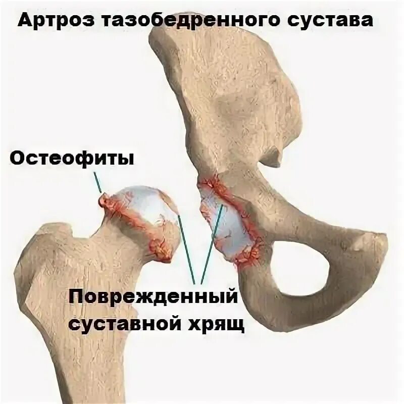 Коксартроза 2 степени тазобедренного сустава без операции. Коксартроз 4 степени тазобедренного сустава. Диета при остеоартрозе тазобедренного сустава 2 степени. Тазобедренный артроз народные средства. Бандаж при остеоартрозе тазобедренных суставов.