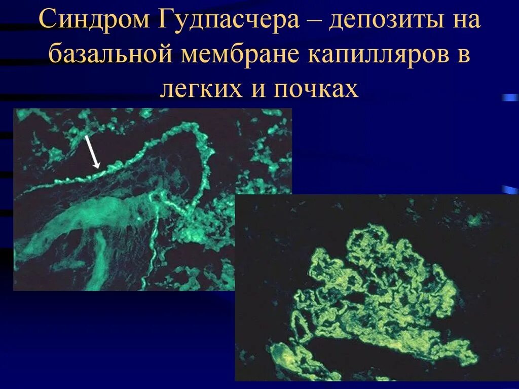 Синдром гудпасчера это. Синдром гудпасчера презентация. синдром гудпасчера рентгенограмма. синдром гудпасчера гистология.