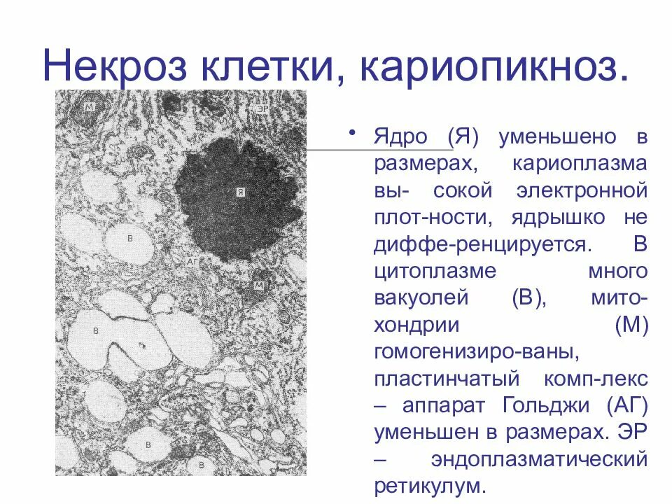 Микроскопические изменения в клетках. Кариопикноз кариорексис кариолизис апоптоз. Некроз ядра клетки. Изменения клетки при некрозе. Смерть клетки некроз.