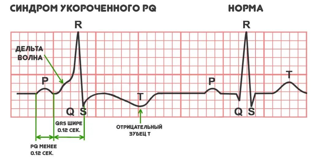 Pq сек