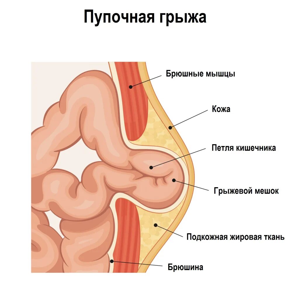 Брюшная грыжа симптомы и лечение. Рецидивная пупочная грыжа. невправляемая пупочная грыжа. пупочная грыжа анатомия.