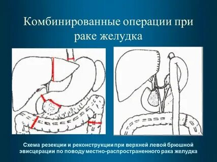 Сколько времени длится операция легких