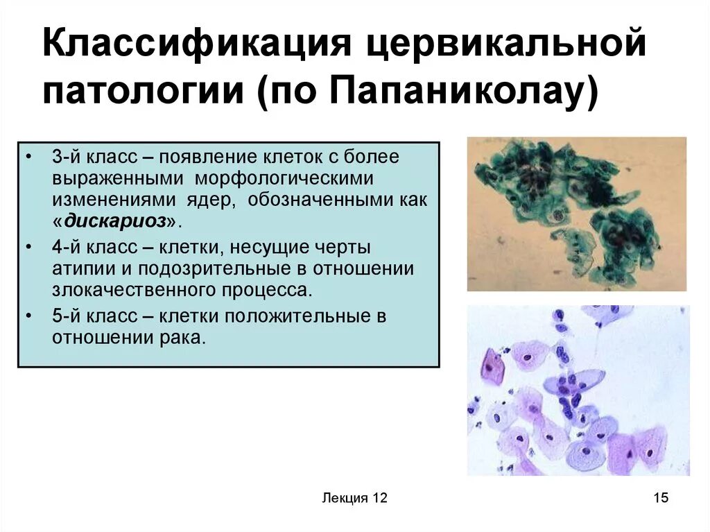 Клетки без признаков атипии. Классификация Папаниколау патологии шейки матки. Цитограмма классификация по Папаниколау. Классификация по Папаниколау 3 класс. Мазки по Папаниколау классификация.