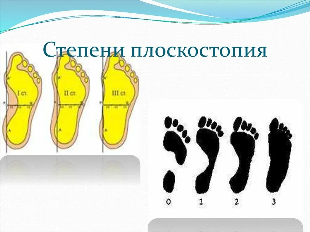 Продольно-поперечное плоскостопие 2 степени. Плоскостопие 1 2 3 степени. Продольно-поперечное плоскостопие и вальгус 3 степени. Плоскостопие 3 степени вид сбоку. Плоскостопие 2 степени что это.