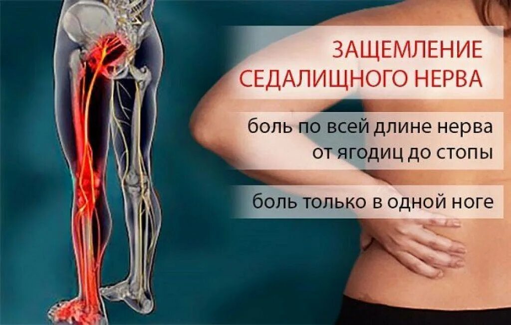 Защемление седалищного нерва в ягодице и ноге. Сидалеч седалищный нерв. защемление седалищного нерва. защемление селалищногоинерва. седалищный нерв симптомы.