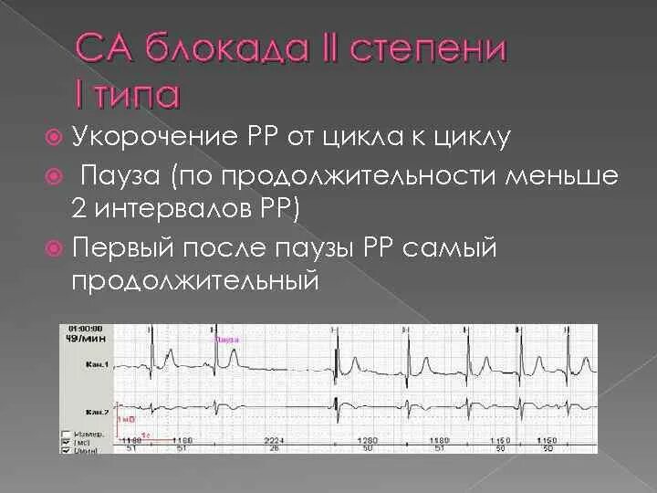 Синоатриальная блокада 2 степени 1 типа. Синоатриальная блокада 2 степени 2 типа. Синоатриальная блокада Мобитц 1 ЭКГ. Са блокада 2 степени Мобитц 1 на ЭКГ. Са блокада степени