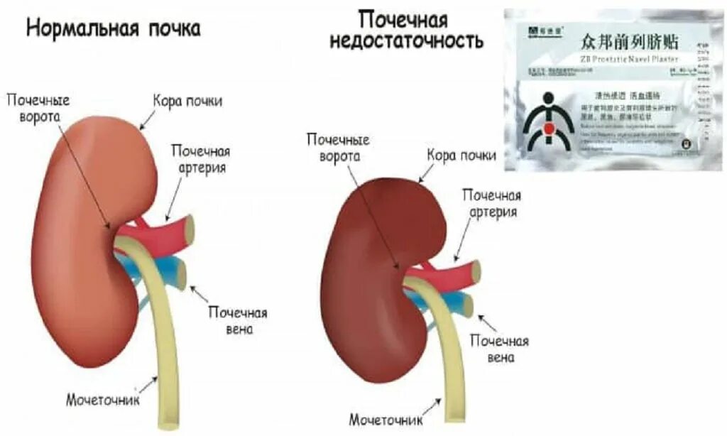Почки простата мочевой пузырь. Внутреннее строение мочеполовой системы женщин. Простата почки. Хроническая почечная недостаточность. Мочевая система человека схема.