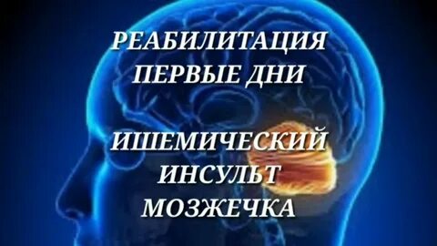 Ишемический инсульт мозжечка