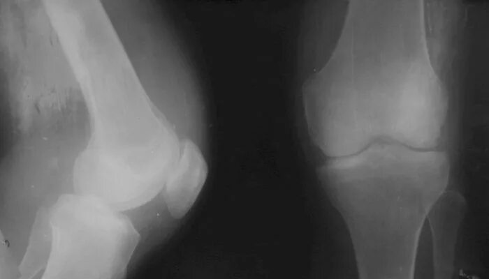 Ювенильный артрит коленного сустава рентген. Синовит коленного сустава рентген. Ревматоидный артрит коленного сустава рентгенограмма. Ревматоидный артрит коленного сустава рентген.