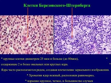 Острая лимфатическая лихорадка