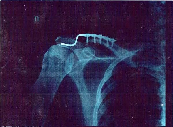 Вывих плечевого сустава на рентгенограмме. Анатомия акромиально-ключичного сочленения. Вывих акс плечевого сустава. Разрыв акромиального плечевого сустава. Перелом ключицы остеосинтез.