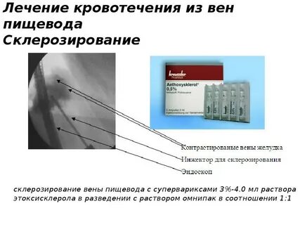 Кровотечение из варикозных вен пищевода мкб 10