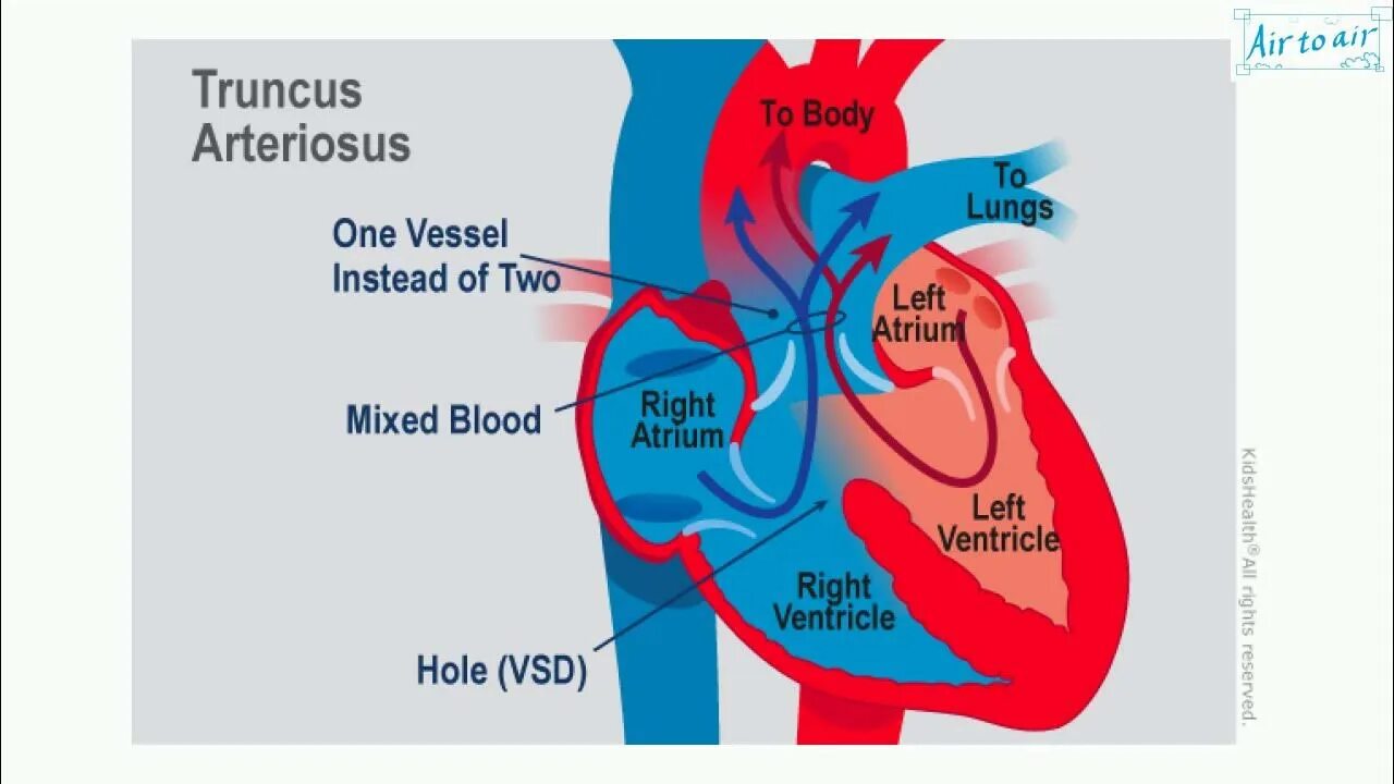 Plexus arteriosus. Трункус артериозус. общий артериальный ствол гемодинамика. общий артериальный ствол тип 1. persistent truncus arteriosus.