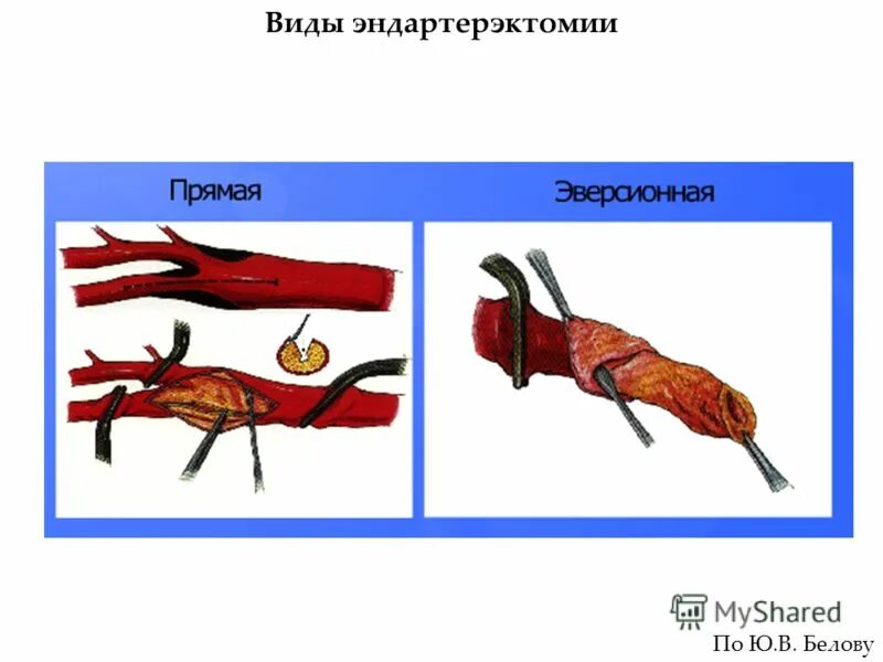 Эверсионная каротидная эндартерэктомия