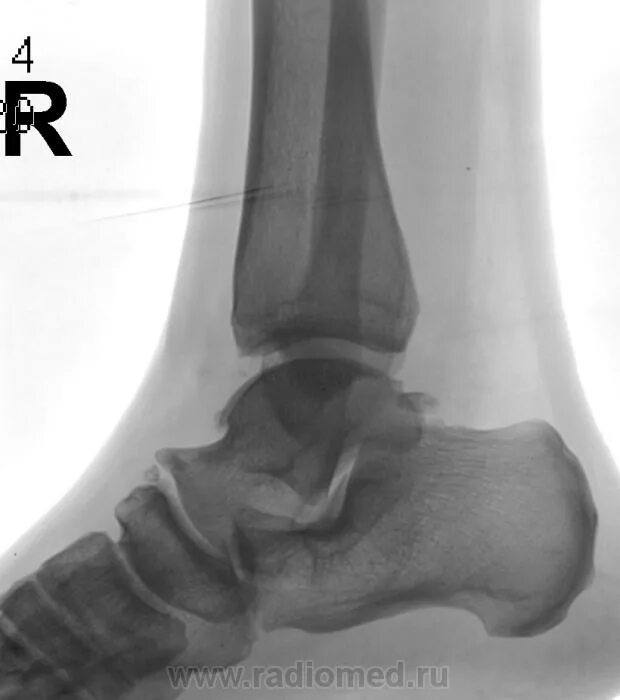 Голеностопный сустав норма. Голеностопный сустав рентген норма. Латеральная лодыжка рентген. Голеностоп сустав рентген. Голеностоп рентгенанатоми\.