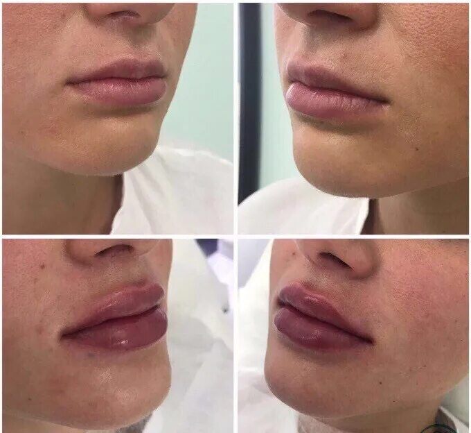 Контурные губы до и после фото. Естественные губы гиалуроновой.