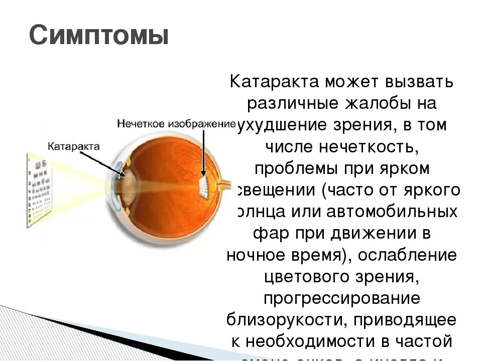 Зрение 1 симптомы. Передне капсулярная катаракта. Глазные болезни катаракта таблица. Катаракта глаза симптомы.