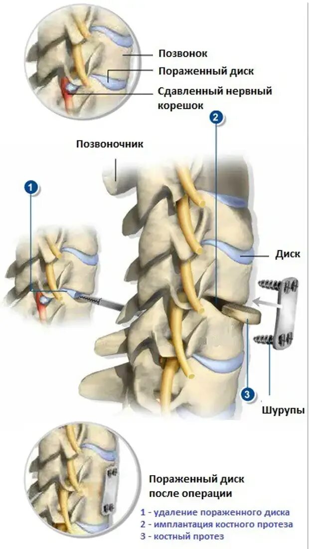 Грыжа межпозвонкового диска операция. Операция на межпозвоночный диск поясничного отдела. Остеохондроз шейного отдела грыжа межпозвоночного диска. Операция грыжи шейного отдела позвоночника. Операция по замене позвоночника