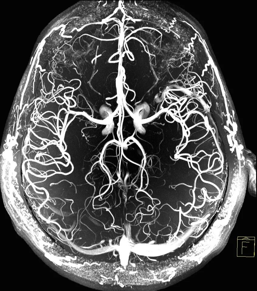 МР-ангиография сосудов головного мозга. МР-ангиография сосудов головного мозга+мрт головного мозга. Кт томограмма головного мозга. Кт ангиография сосудов головного мозга. Кт головы москва