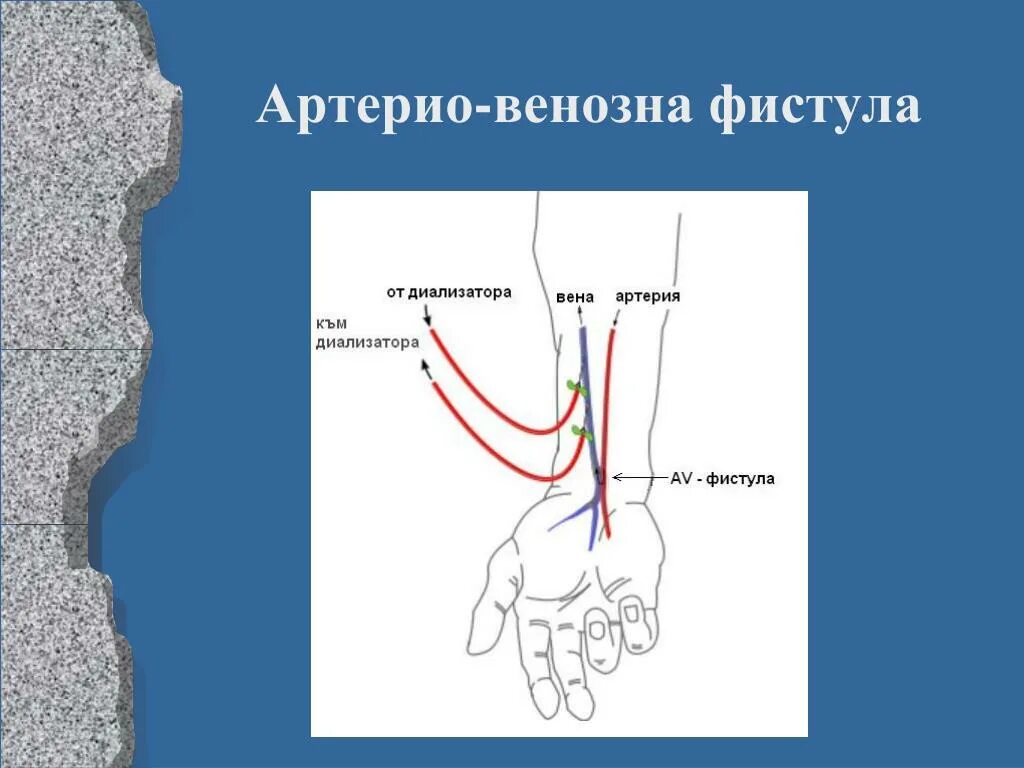 Фистула. Артерио-венозная фистула.