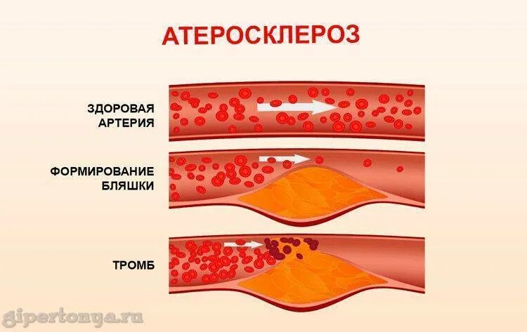 Формирование атеросклеротической.бляшки рисунок. Тромб и бляшка разница