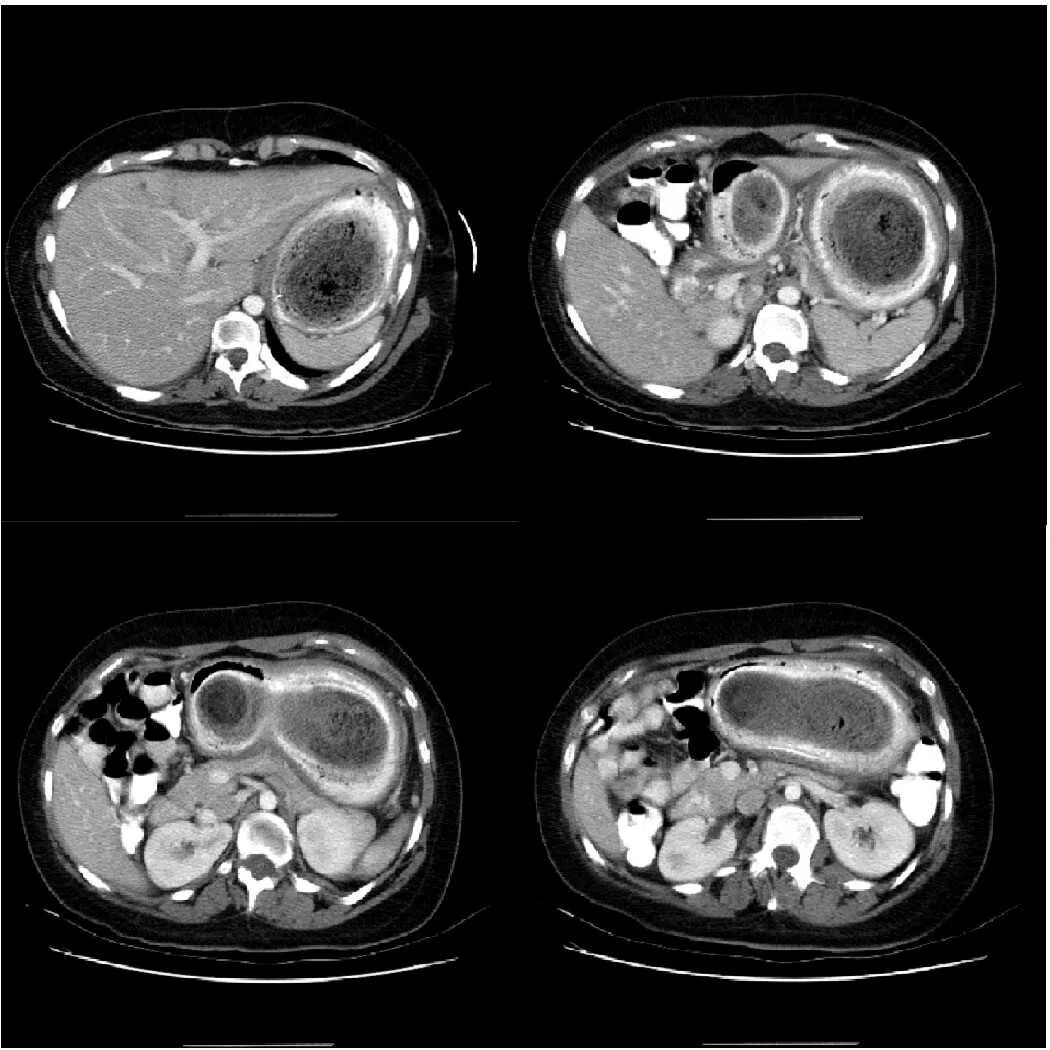 Кт брюшной полости и забрюшинного пространства. Томограмма брюшной полости кт. Кт ОБП С контрастированием норма. Снимки кт брюшной полости.
