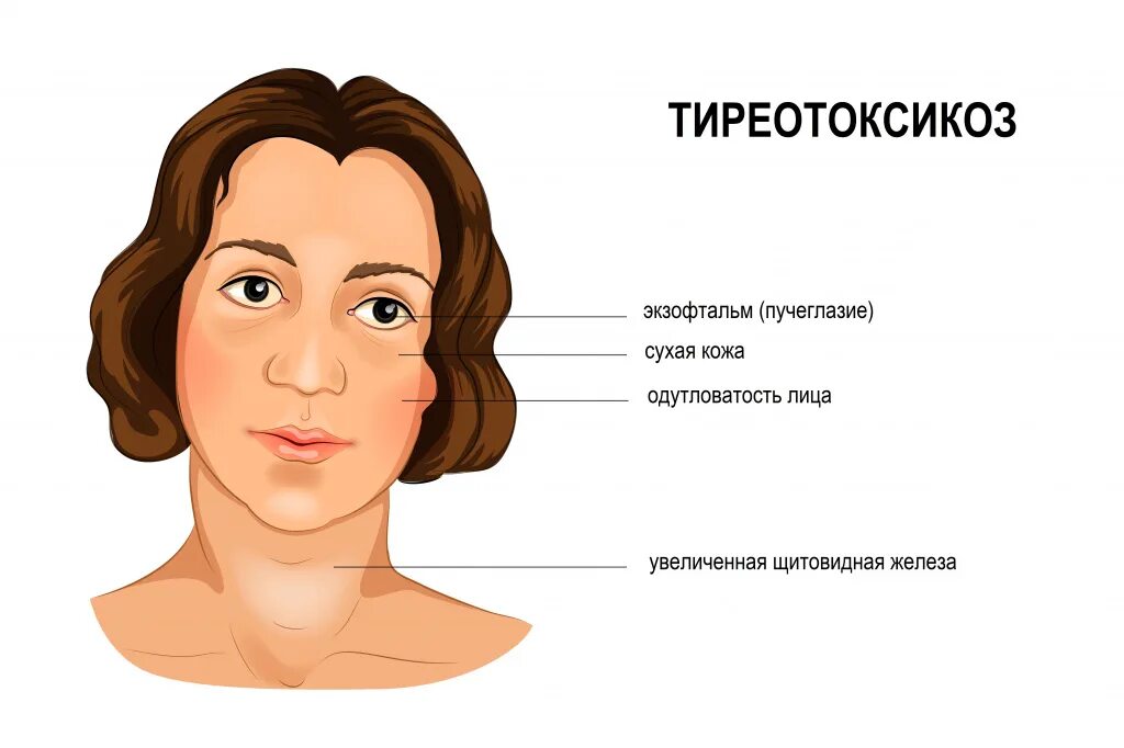 Тиреотоксикоз щитовидной. Тиреотоксикоз щитовидной железы. Симптомы щитовидной железы у женщин.