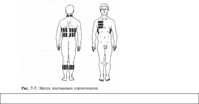 Сколько держать горчичники на спине. Зоны постановки горчичников. Места постановки горчичников схема. Схема постановки горчичников при кашле. Постановка горчичников места постановки.