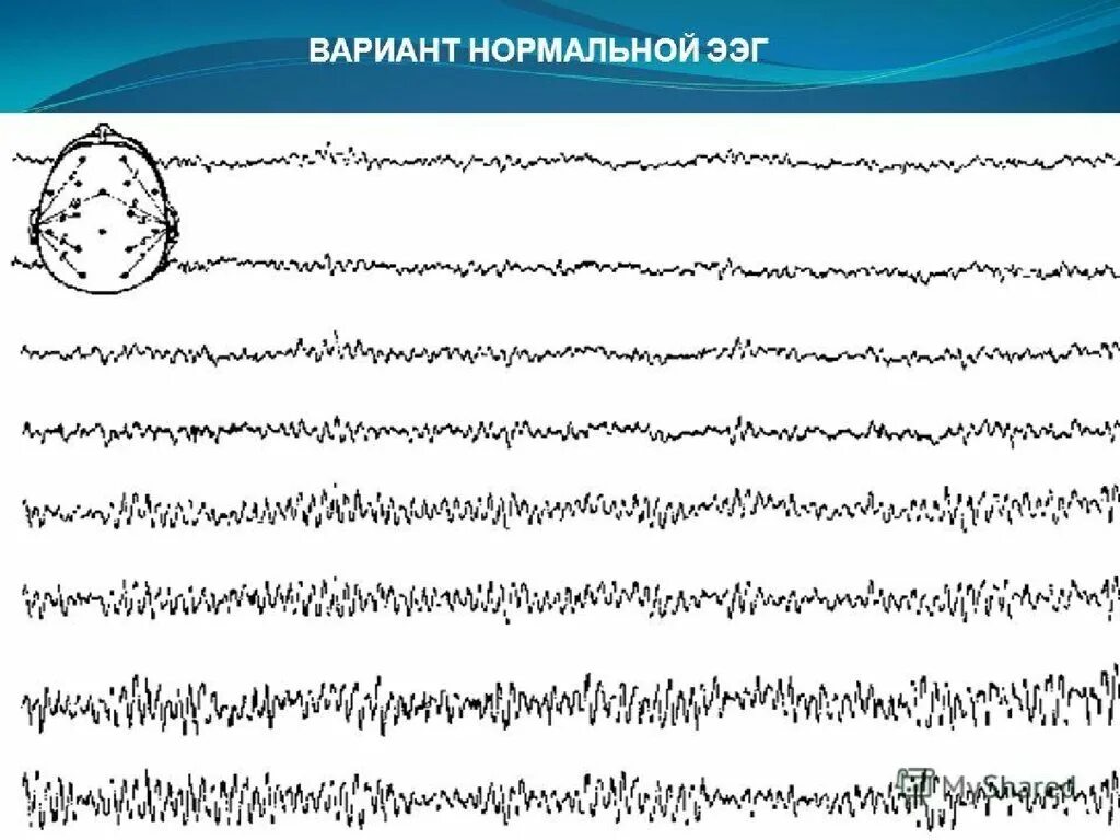 Как выглядит ээг. Электроэнцефалография (ЭЭГ) метод исследования. ЭЭГ принцип метода. ЭЭГ В психиатрии. ЭЭГ схема.