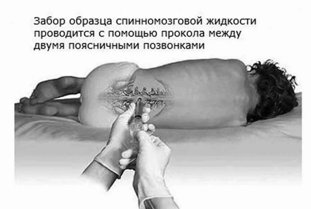 Проведение спинномозговой пункции