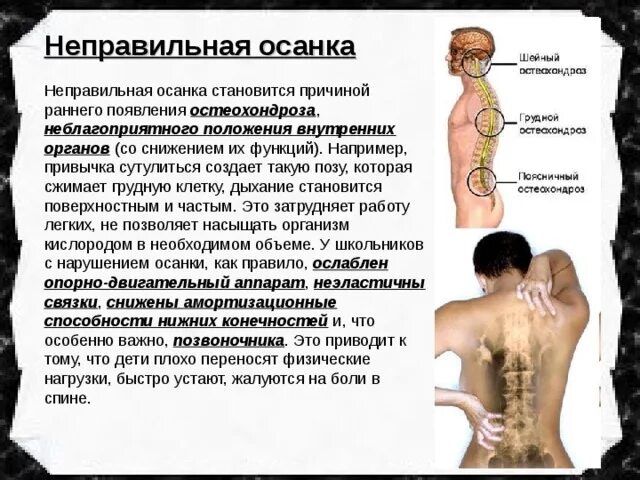 К нарушению функции может привести. Неправильная осанка может привести к. Неправильная осанка сколиоз. Неправильная осанка может привести к искривлению позвоночника. Нарушение осанки приводит к расстройству.